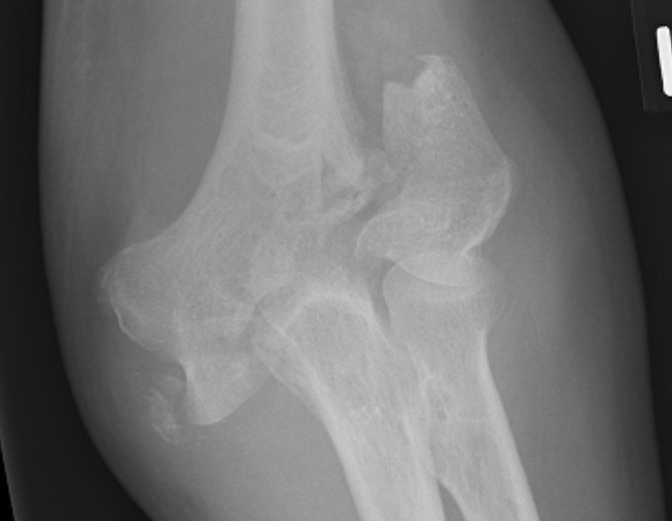 Elbow Lateral Condyle Fracture 2